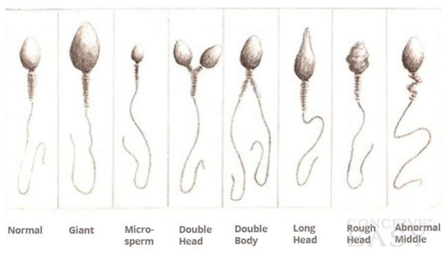 There are many causes of abnormal sperm Morphology. Some common ones include smoking, drinking alcohol or using drugs that affect the reproductive system such as marijuana; having chemotherapy treatments like radiation therapy to treat cancer cells in your body 
