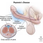 Penile Traction Therapy For Peyronie’s Disease