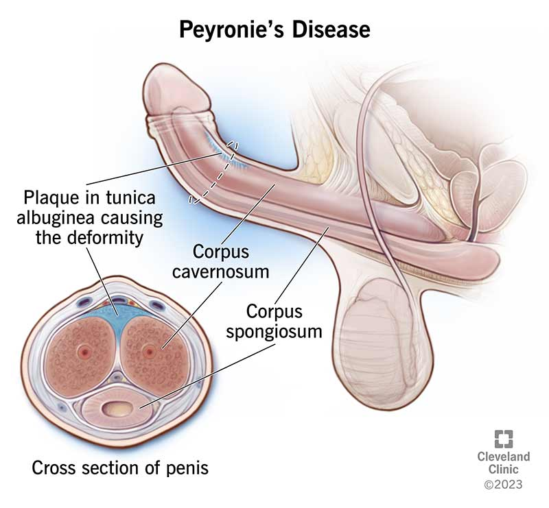 Penile Traction Therapy For Peyronie’s Disease